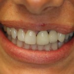 Smile Redesign - This case required a combination of crowns, veneers and a bridge.